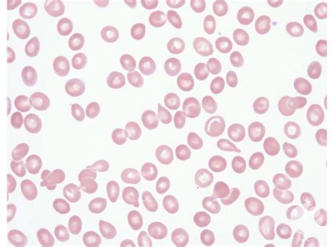 Dacrocyte .